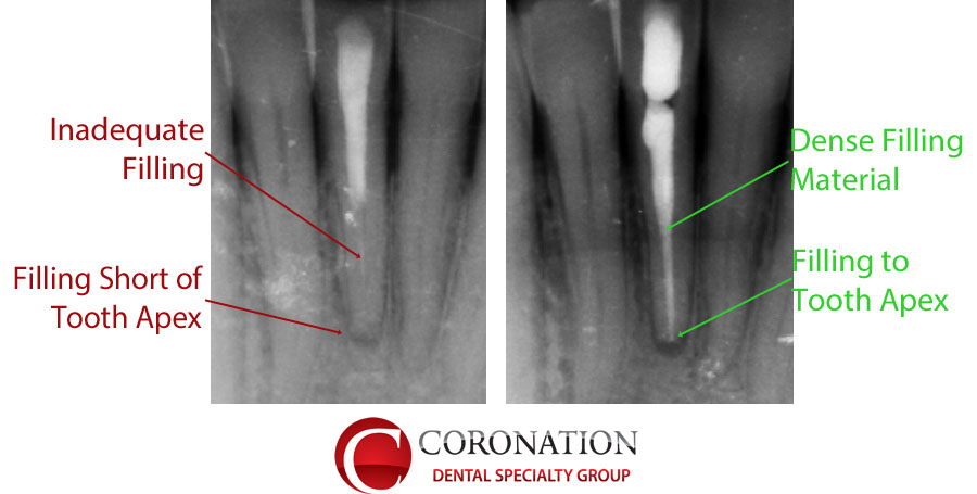 Root canal in a lower incisor with inadequate fill that requires root canal retreatment.